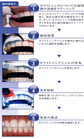 オフィスホワイトニングの流れ