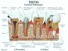 虫歯と歯周病